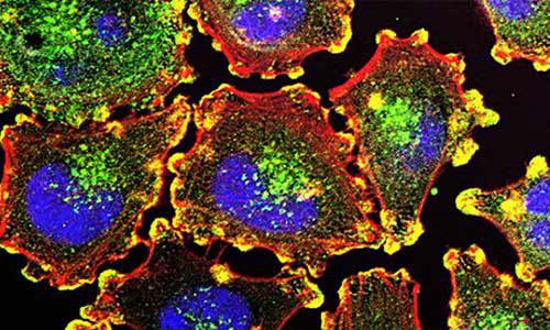 Células de câncer de melanoma metastático: Foto: National Institutes of Health via Wikimedia Commons.